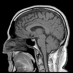 MRI